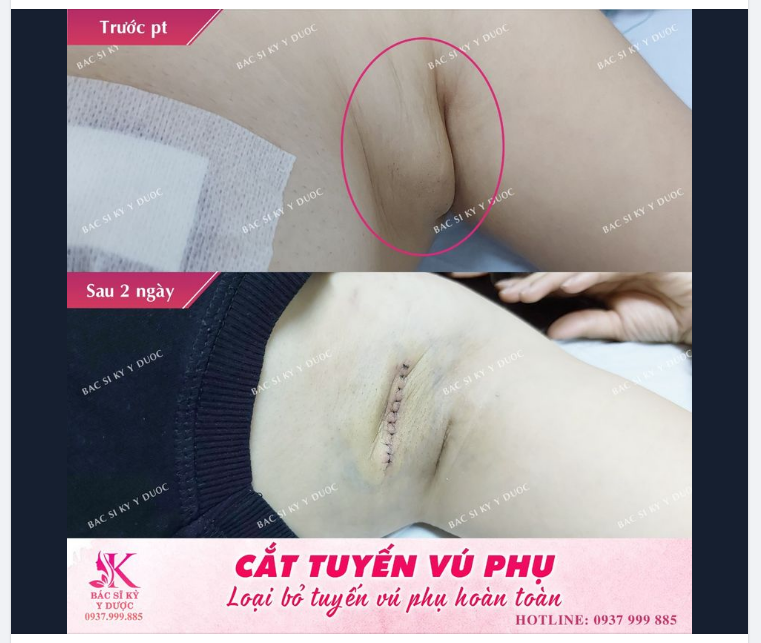 LOẠI BỎ TUYẾN VÚ PHỤ - TỰ TIN DIỆN ÁO HAI DÂY