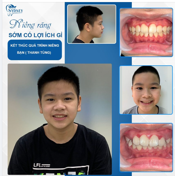 Lợi ích của việc niềng răng sớm cho trẻ em