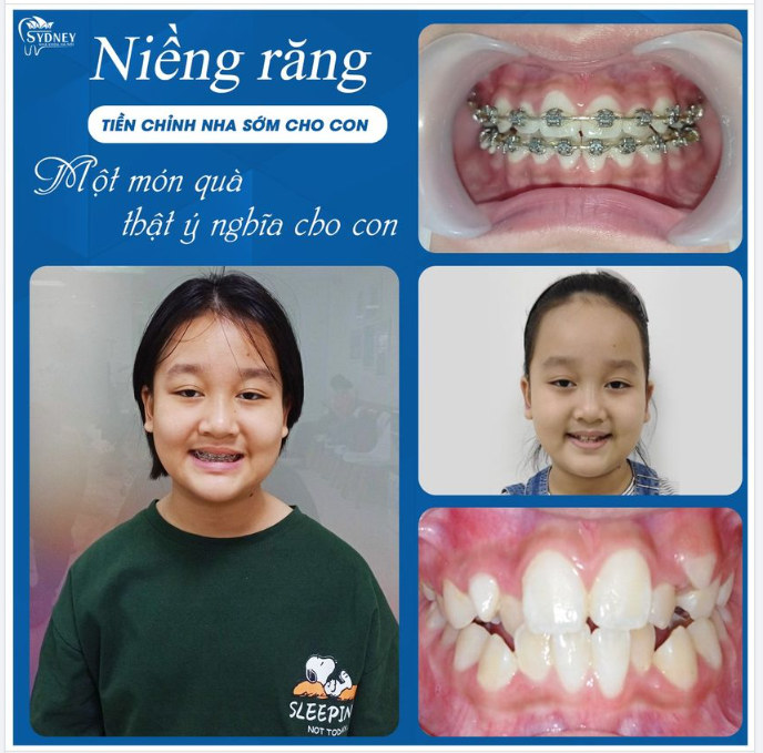 Lợi ích khi cho trẻ niềng răng sớm
