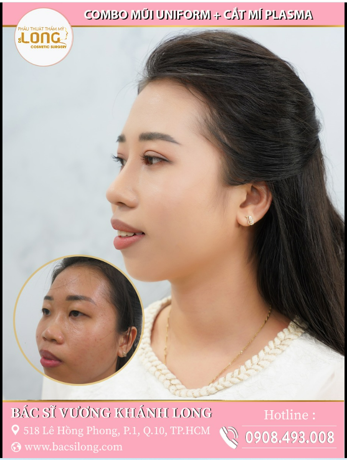 LỘT XÁC SAU COMBO NÂNG MŨI + CẮT MÍ