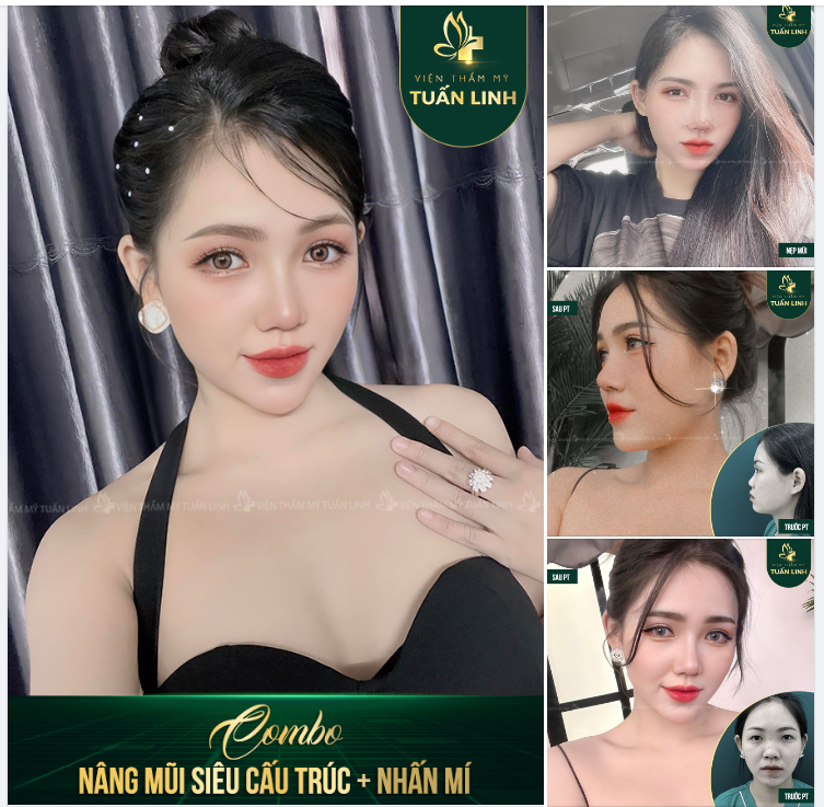 Lột xác sau combo nâng mũi siêu cấu trúc + Nhấn mí