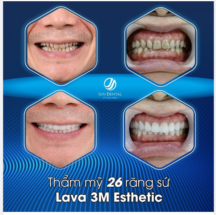 Lựa chọn thẩm mỹ răng sứ 26 răng chất liệu Lava 3M Esthetic