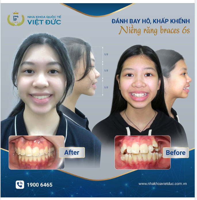 LÝ DO KHIẾN BẠN NIỀNG RĂNG LÀ