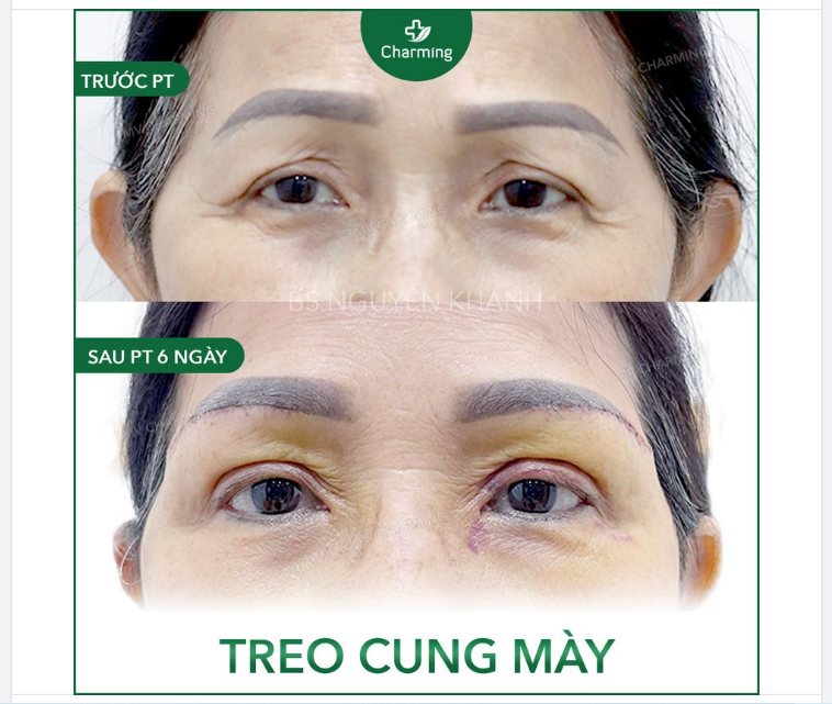 Mặc dù công dụng chính của phẫu thuật nâng cung mày y như cái tên của nó nâng đường cung mày về lại vị trí của thanh xuân.