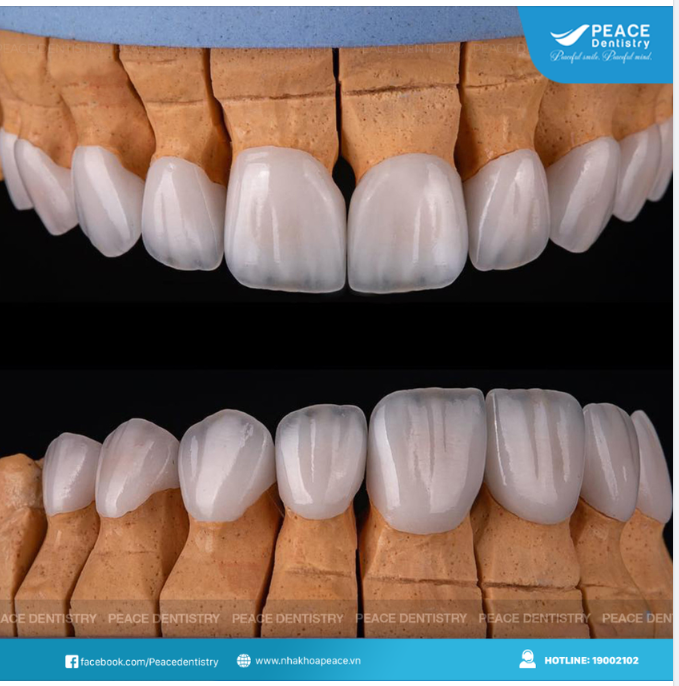 MẶT DÁN SỨ VENEER – GIỮ LẠI TỐI ĐA RĂNG THẬT