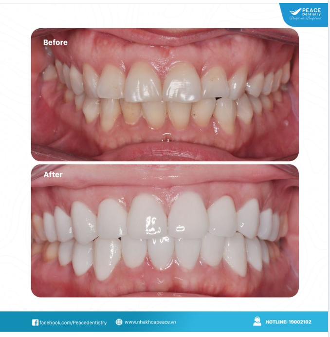 MẶT DÁN SỨ VENEER - MỎNG NHẸ HẠN CHẾ XÂM LẤN RĂNG THẬT