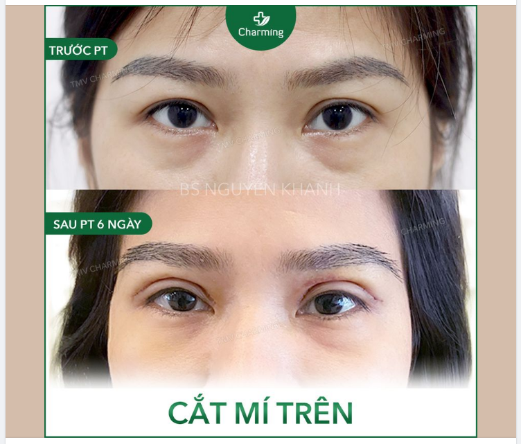 Mắt hai mí bẩm sinh chưa hẳn đã đẹp, tuổi trẻ chưa chắc mí không sụp.