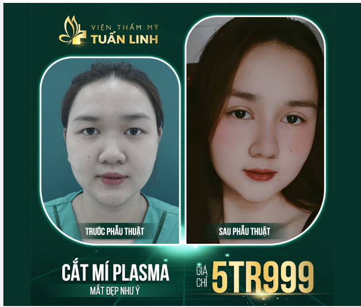 MẮT MỘT MÍ, MÍ SỤP, NHIỀU DA DƯ MỠ THỪA LÀM KHUÔN MẶT BỊ GIÀ NUA  '' Đánh bay'' chỉ trong vòng 30 phút.