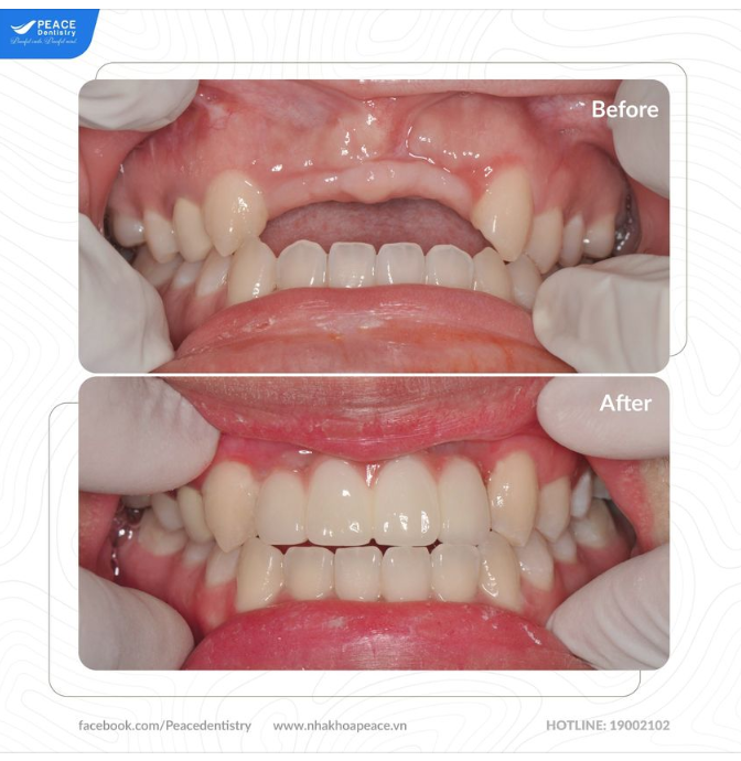  MẤT RĂNG KHÔNG CÒN LÀ VẤN ĐỀ VÌ ĐÃ CÓ TRỒNG RĂNG  IMPLANT