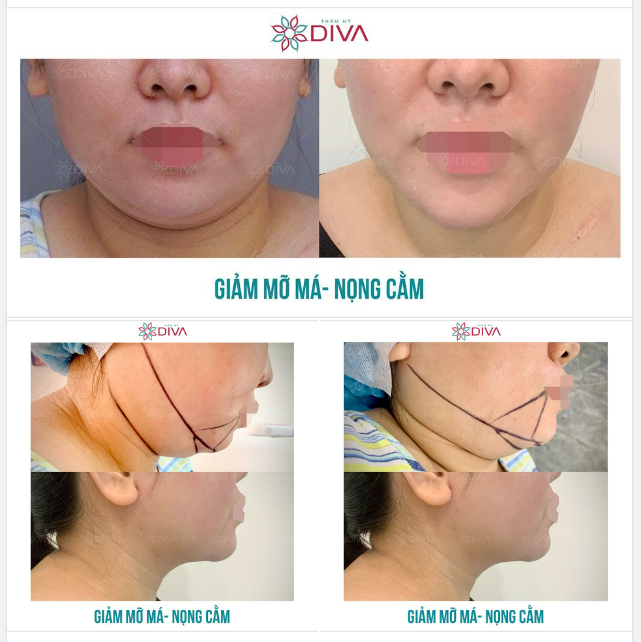 MẶT THANH THOÁT, HẾT NỌNG VLINE SAU THẨM MỸ GIẢM MỠ