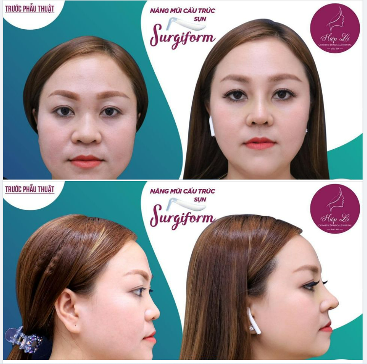 Mặt tròn trịa đầy đặn thì nên làm MŨI gì cho đẹp