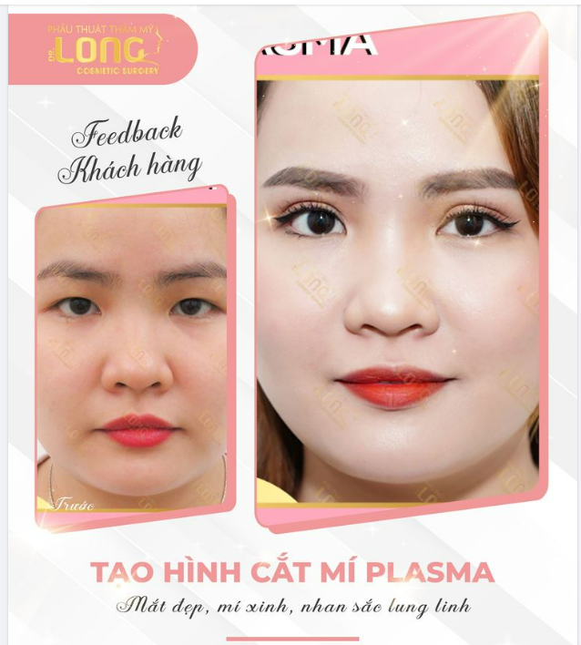 ​​​​​​​Mắt yếu cơ1 mí mắt nhỏ sụp mí mí không đều bọng mỡ