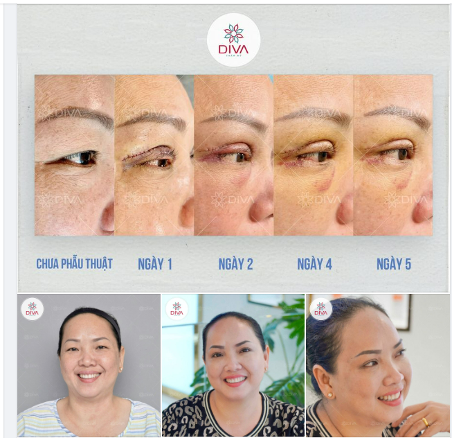 MÍ ĐỀU, MẮT TO CUỐN HÚT SAU CẮT MÍ MẮT