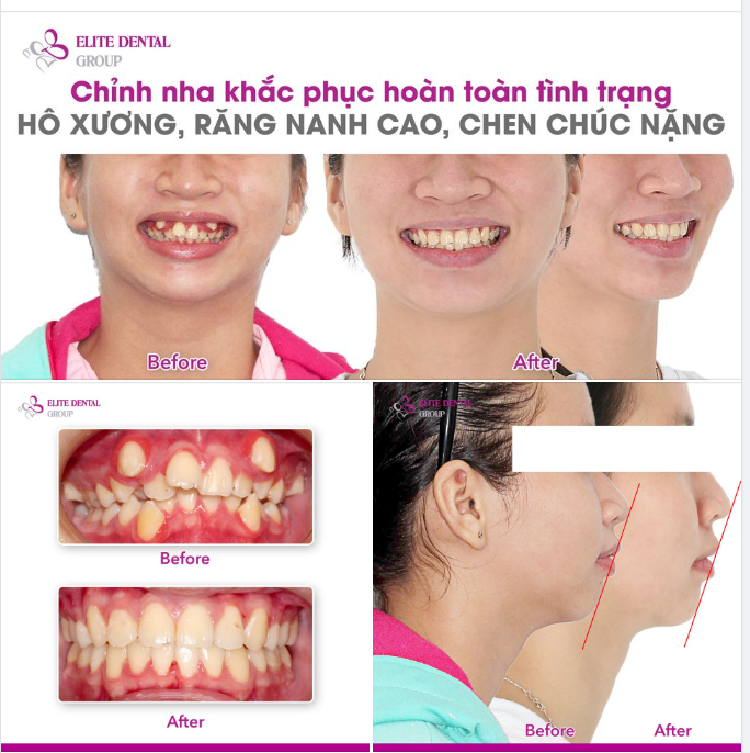 Minh Thư chia sẻ cùng Elite Dental trong buổi tái khám nhận hàm duy trì.