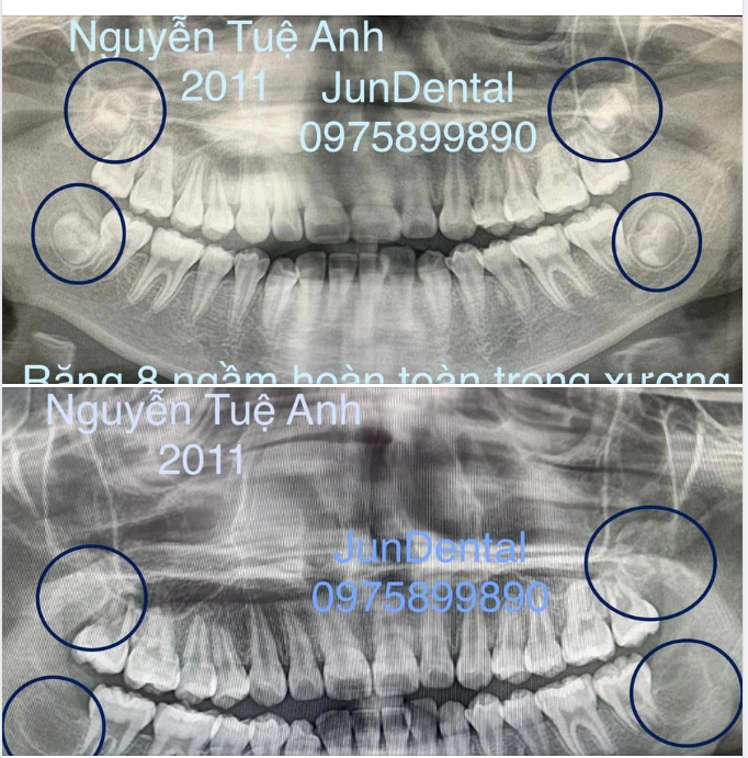 MỞ ĐẦU NGÀY MỚI VỚI MỘT CA NHỔ RĂNG SỐ 8 SIÊU KHÓ.