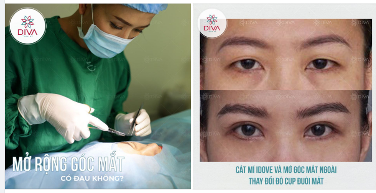 MỞ RỘNG GÓC MẮT CÓ ĐAU KHÔNG