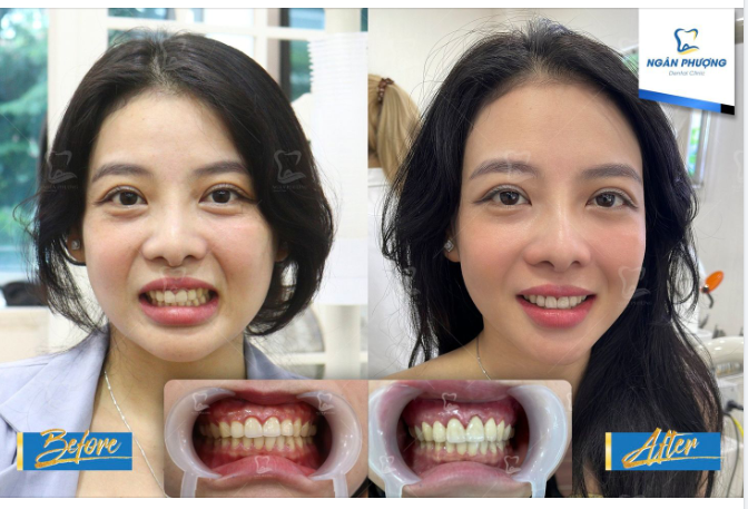 Một bước đến với nụ cười đẹp xinh chỉ dài 2mm