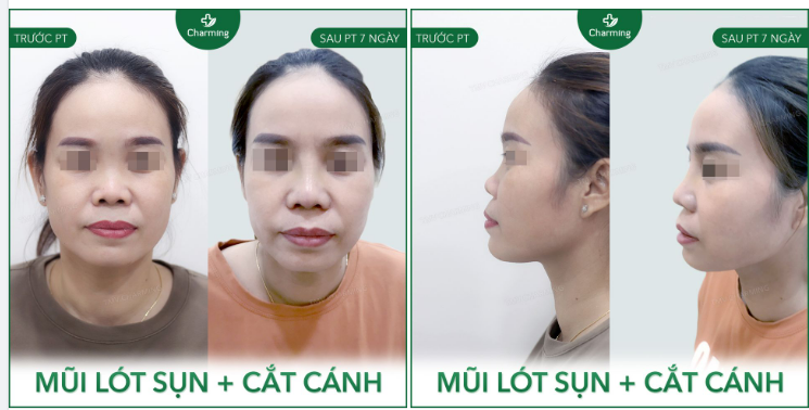Một chiếc mũi nhiều khuyết điểm nhưng lại được cải thiện khá “ổn áp” nhờ vào nâng mũi lót sụn.