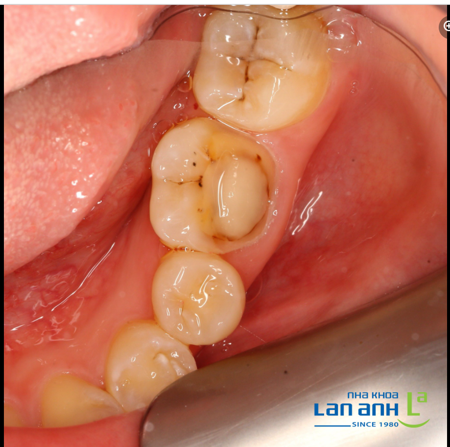  Một trường hợp tái tạo răng đúng chuẩn của bác sĩ Liên, chi nhánh Sala, quận 2!