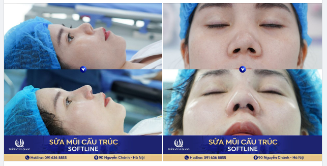 Mũi BAO XƠ đã được HỒI SINH như thế nào