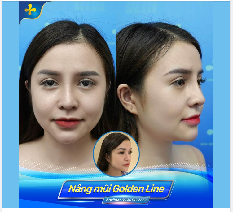 Mũi đã tiêm filler nhưng không đạt được kỳ vọng như mong muốn, bạn gái quyết định nâng mũi Golden Line - Dr.Tống Hải.