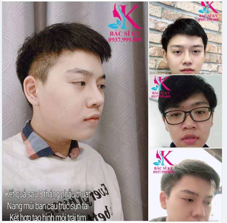 MŨI ĐẸP CHO NAM GIỚI HÓA NAM THẦN TẠI BS KỲ Y DƯỢC