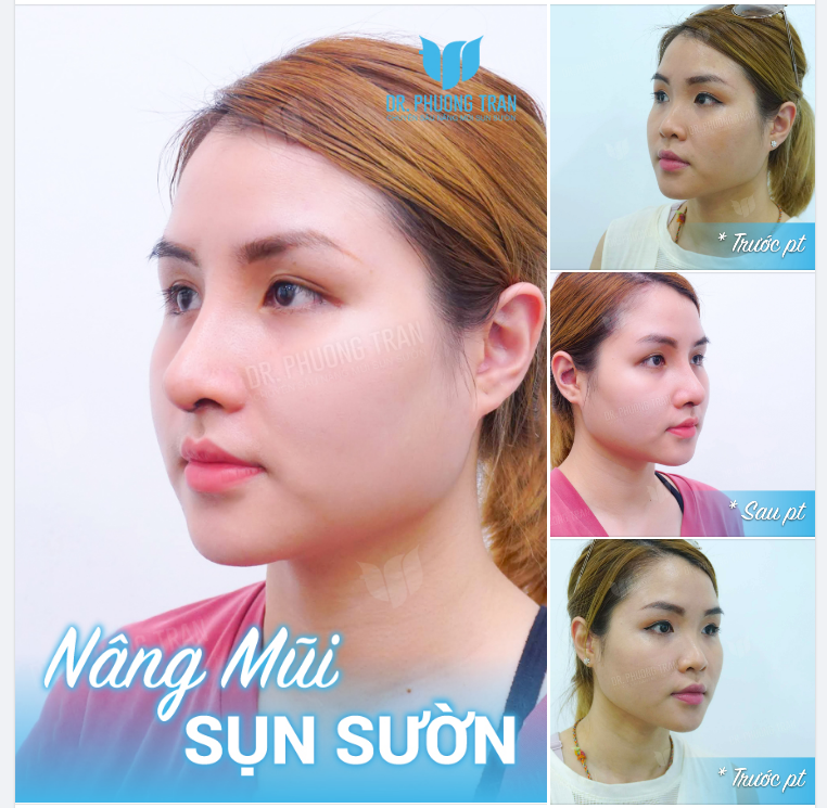 Mũi đẹp là thứ có thì tốt, Còn không có thì làm sụn sườn ngay và luôn…!