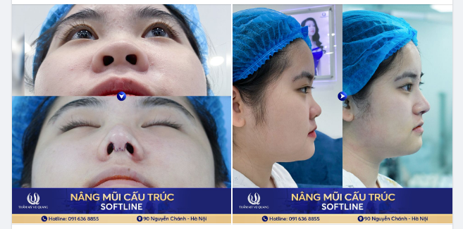 MŨI ĐẸP NHƯ Ý - CHI PHÍ LI TI