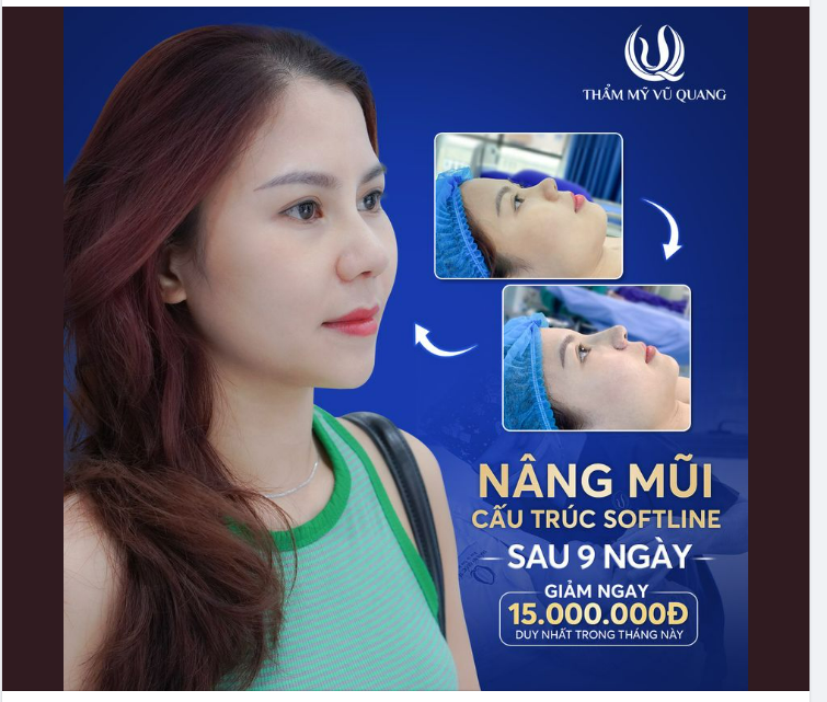 MŨI ĐẸP NHƯ Ý - CHI PHÍ LI TI