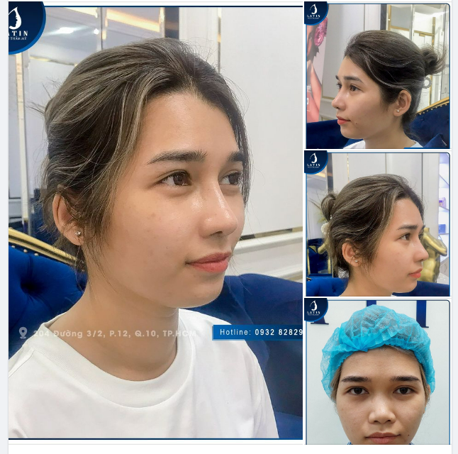 Mũi em mới nâng 1 tháng, em ưng lắm luôn ạ