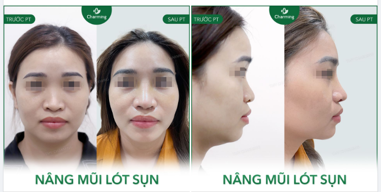 Mũi S-line thì đẹp đó, nhưng mà cái chữ S của bạn này nó lạ lắm ’) Vì cái nét cong trên của chữ S hơi sâu một xíu, kể cũng kỳ.
