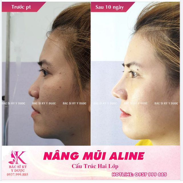 Mũi tròn 10 tuổi