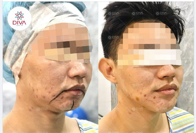 MUỐN CẢI THIỆN CẰM LẸM NHƯNG SỢ CẮT XƯƠNG, GIẢI PHÁP LÀ GÌ