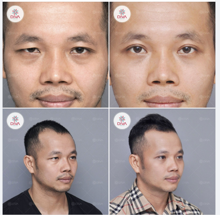 NAM GIỚI THƯỜNG E NGẠI KHI THẨM MỸ MẮT VÌ SAO
