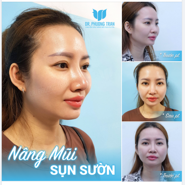 Nắng hoàng hôn ai tô màu đỏ Tìm mũi đẹp, ngỏ lời với bác sĩ Phương…!