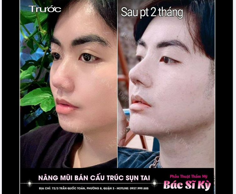 Nâng mũi Aline phong thủy dành cho nam Tại ​​​​​​​ Bs Kỳ Y Dược.