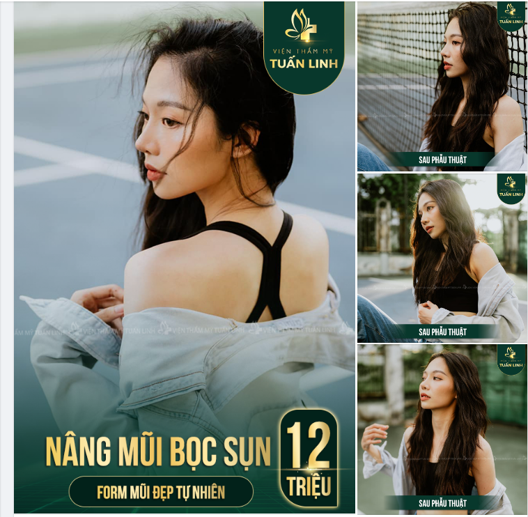 Nâng mũi bọc sụn - Lựa chọn hàng đầu cho những bạn thích dáng mũi tự nhiên