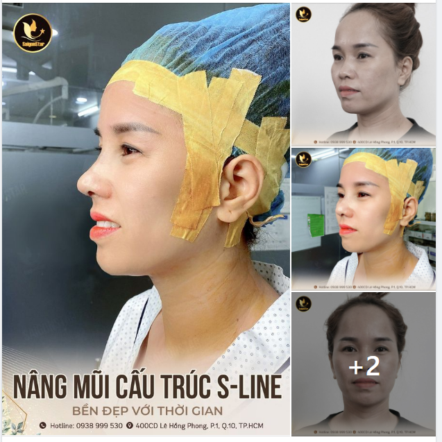 NÂNG MŨI CẤU TRÚC DÁNG S-LINE  MŨI BỀN ĐẸP VỚI THỜI GIAN