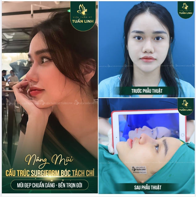 NÂNG MŨI CẤU TRÚC - MŨI ĐẸP CHUẨN DÁNG - BỀN TRỌN ĐỜI.