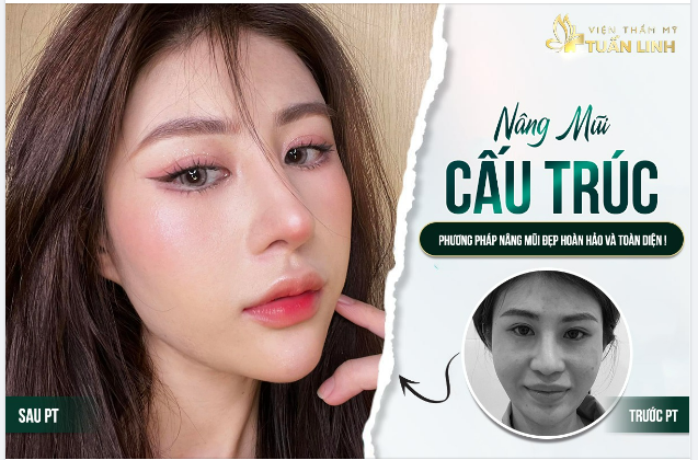 Nâng mũi cấu trúc - phương pháp nâng mũi đẹp toàn diện