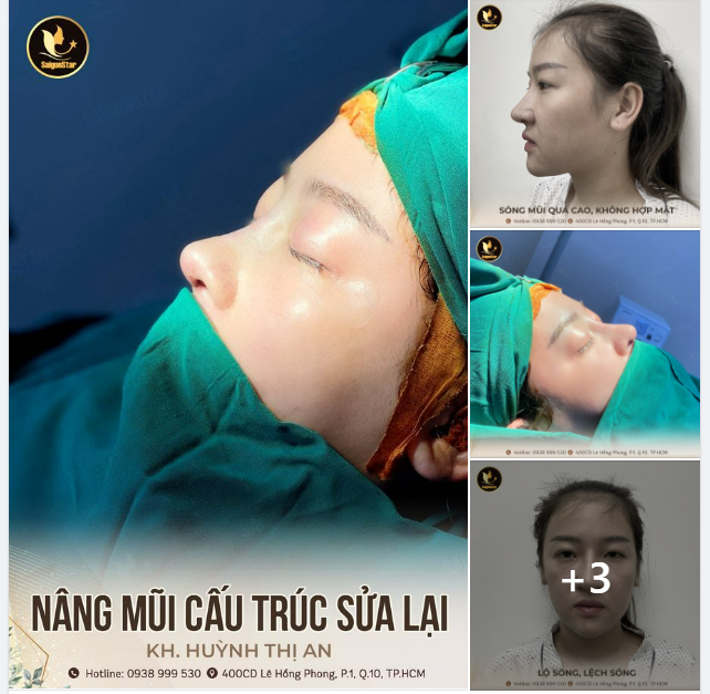 NÂNG MŨI CẤU TRÚC SỬA LẠI – ĐẸP BỀN TRỌN ĐỜI