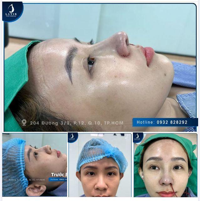 NÂNG MŨI CẤU TRÚC - SỤN SURGIFORM TỪ MỸ