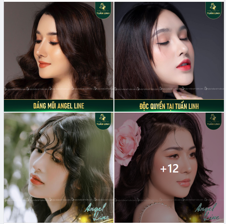 Nâng mũi dáng Angel line chỉ với 9tr9 tại Tuấn linh