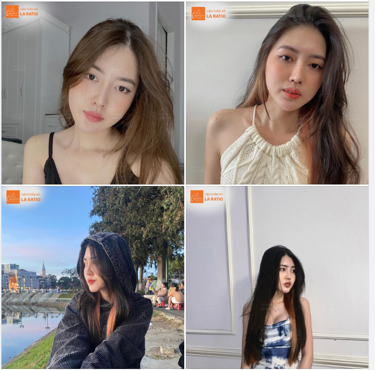 Nâng mũi giá cực tốt, cơ hội GIẢM NGAY 15 TRIỆU