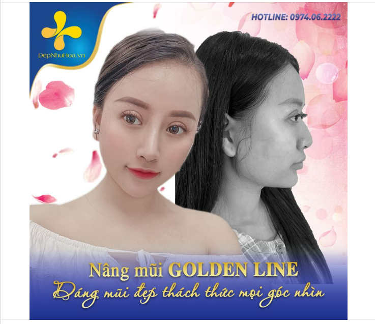 NÂNG MŨI GOLDEN LINE - PHƯƠNG PHÁP CHỈNH SỬA DÁNG MŨI HOÀN HẢO
