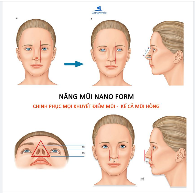 NÂNG MŨI NANOFORM - CAO TÙY CHỌN - SỬA TÙY Ý - AN TOÀN 100%