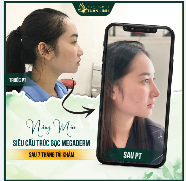 NÂNG MŨI SIÊU CẤU TRÚC BỌC MEGADERM =Mũi đẹp chuẩn phom sau 7 tháng tái khám.