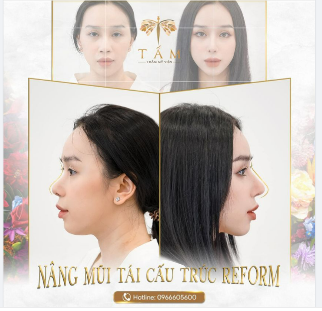 Nâng mũi tái cấu trúc Reform  tái tạo toàn bộ khuyết điểm mũi dù là phức tạp nhất!