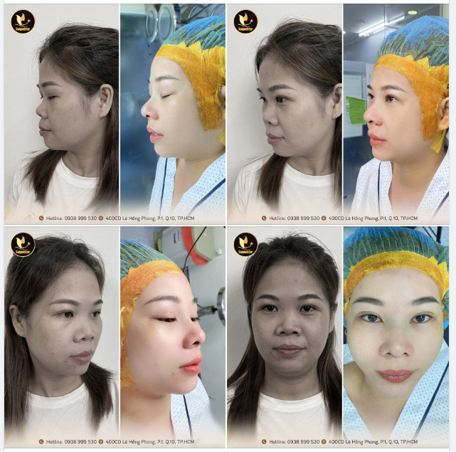 NÂNG MŨI THÁNG 9 – GIẢM ĐẾN 50%