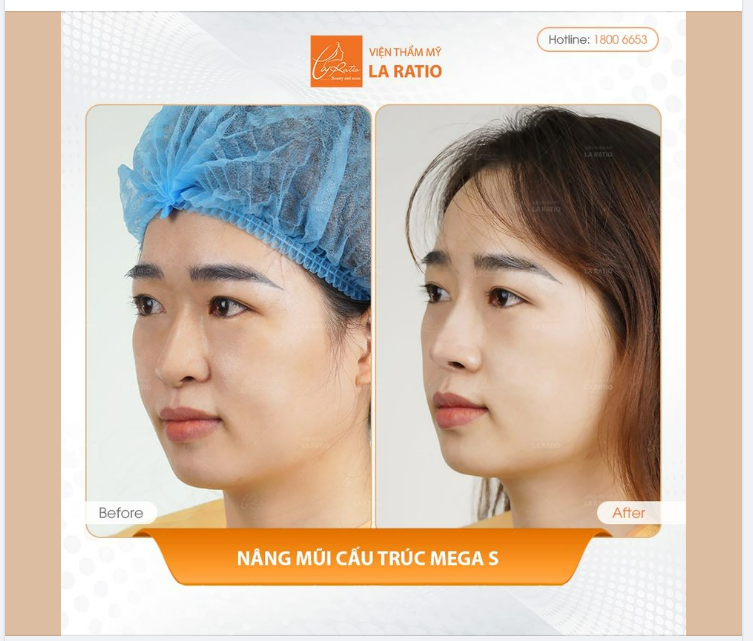 NÂNG MŨI THEO PHONG THỦY LÀ GÌ